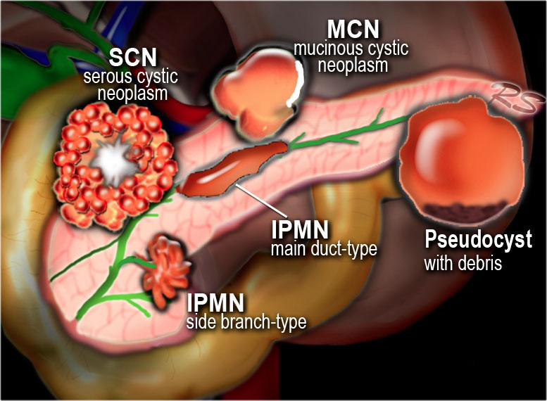 Cisti pancreatica